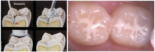  Τοποθέτηση sealant σε οπές-σχισμές και αύλακες δοντιών